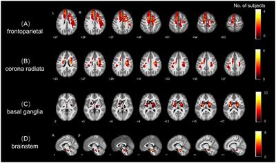 Location matters: altered interhemispheric homotopic connectivity in post-stroke dyskinesia